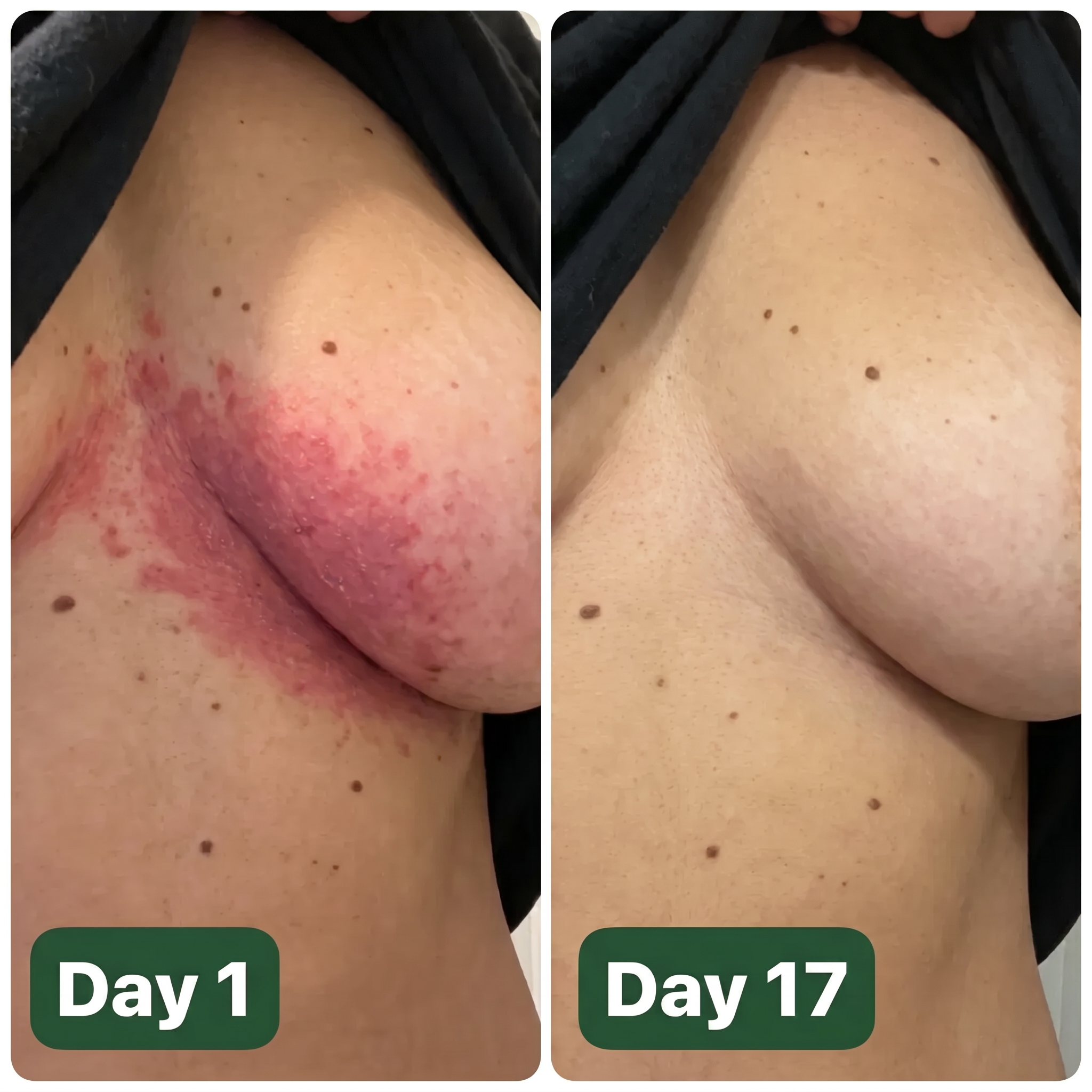Cira - Antifungal Barrier Cream